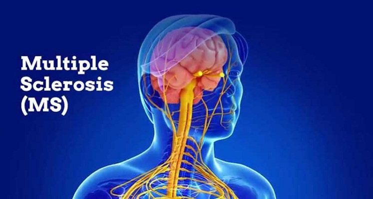 بررسی ارتباط پروتئین های ساختاری میکروارگانیسم ها با بیماری خود ایمنی MS
